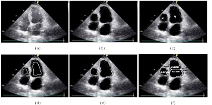  Radial Charge Fitting Curve for the Quantification and Classification of Parameters to Aid Diagnosis of Left Ventricular Hypertrophy